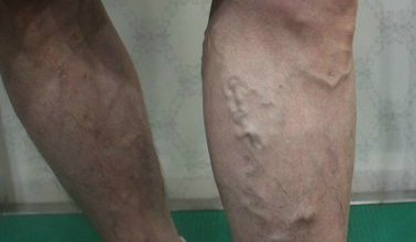 하지정맥류 초기 증상은? 놓치지 말아야 할 5가지 신호 3