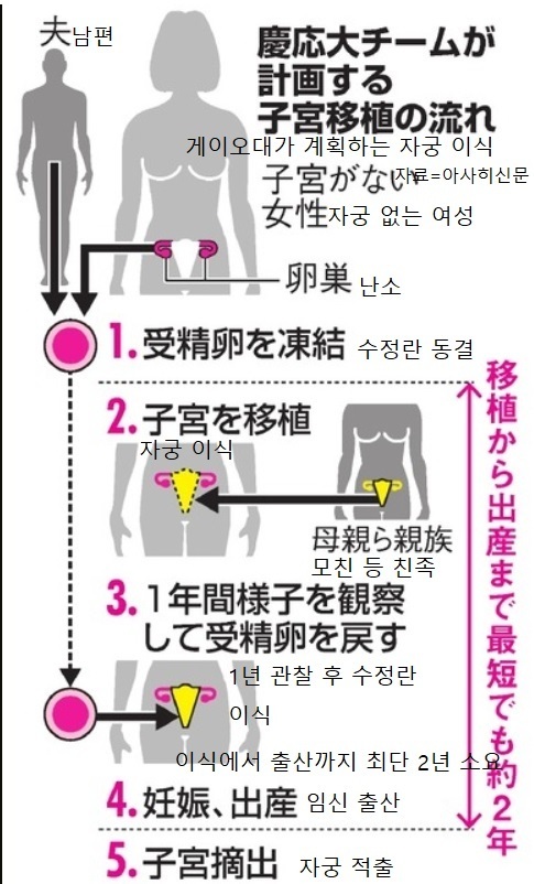 [정보모음] 자궁이식(로키탄스키 증후군)을 통한 출산 시도 (2021.2.18 업데이트)